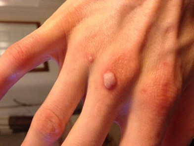 Wart on hand 2