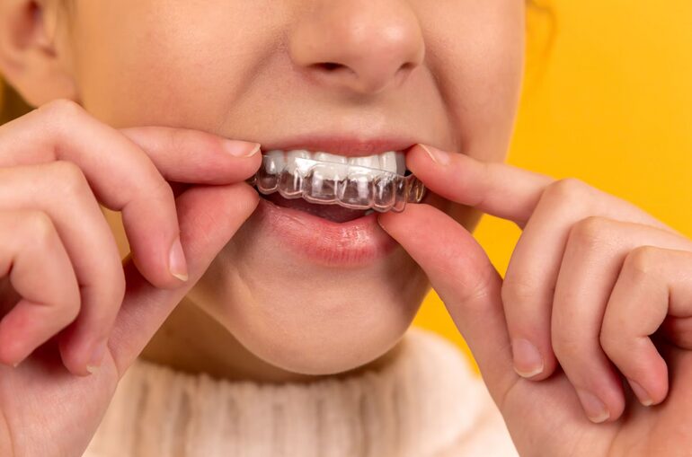 aligners